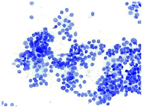 Medullary thyroid carcinoma. Medullary thyroid carcinoma identified ...