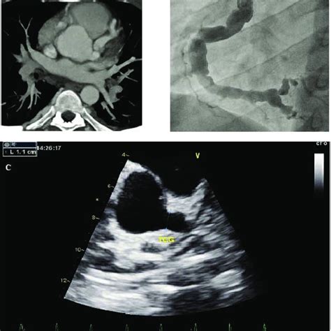 , Coronary artery aneurysms | Download Scientific Diagram