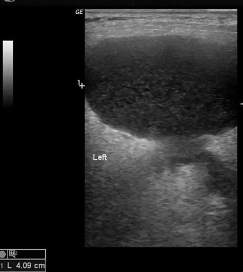 Cystic parotid lesion | Radiology Case | Radiopaedia.org | Parotid ...