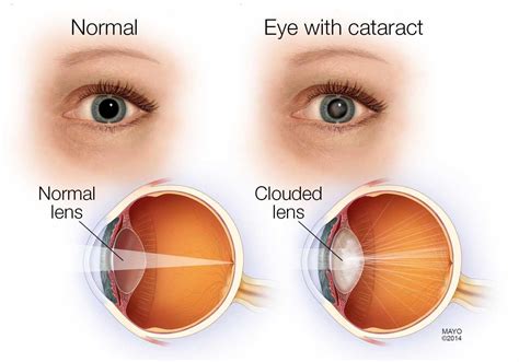 Some Of The Common Eye Diseases In Elderly People - Goggles4u.com