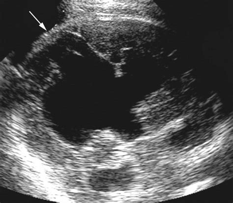 Schizencephaly Ultrasound