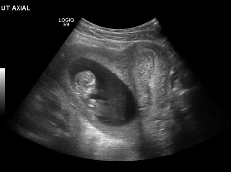 Viable pregnancy in a bicornuate uterus : r/medicine