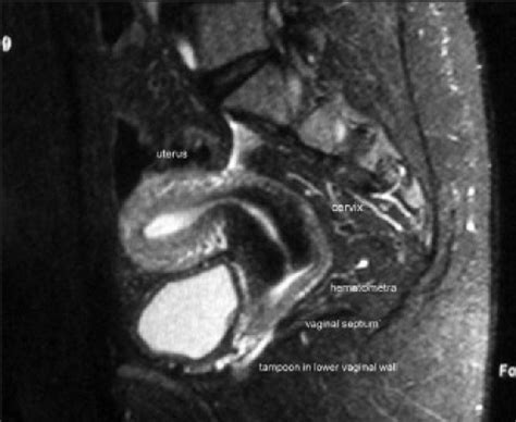 The MRI shows uterus with cervix and upper 2 cm of vagi | Open-i