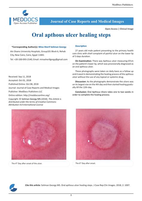 (PDF) Oral apthous ulcer healing steps