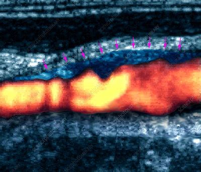 Atheroma plaque, Doppler ultrasound - Stock Image - M175/0298 - Science Photo Library