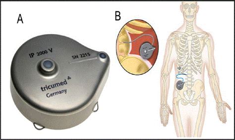 Figure 1 from Intrathecal Morphine Therapy for Chronic Non-malignant Pain Using a ConstantFlow ...