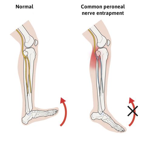 Know All About Drop Foot Treatment, its Causes and Symptoms