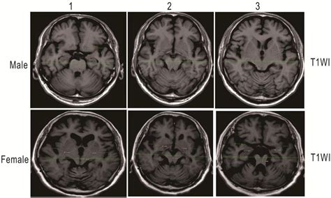 Sylvian Fissure Coronal