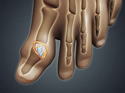 Conceptual image of gout in the big toe. Gout is a form of inflammatory arthritis that causes ...