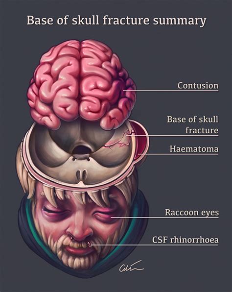 5 signs of a base of skull fracture — artibiotics