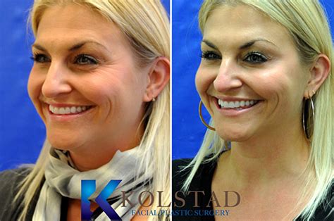 Botox for Crowsfeet Results | Dr. Kolstad - San Diego Facial Plastic ...