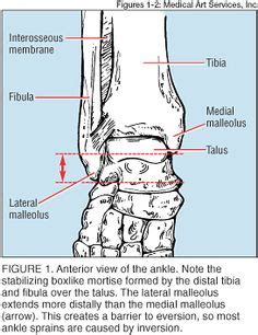 Potts fracture of the lateral malleolus | Surgery and Hematology ...