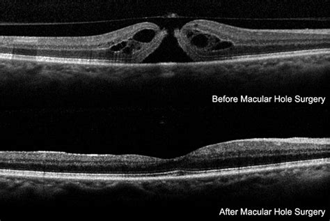 Macular Hole Surgery - Vitreous Retina Macula Consultants of New York