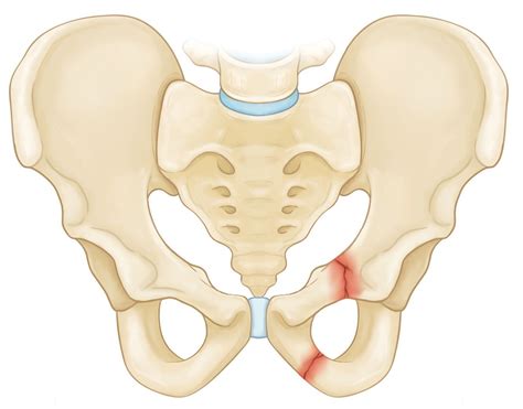 Pin on Pelvic fractures