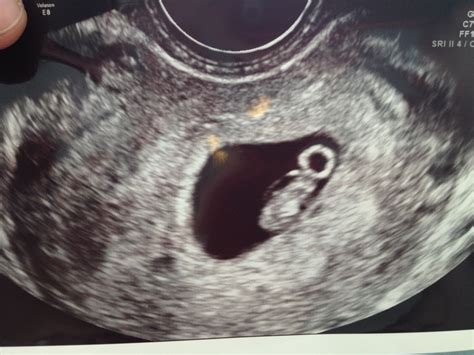 7 Week Ultrasound Heartbeat