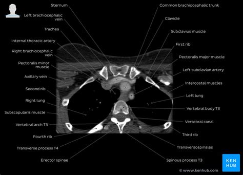 Labeled Chest Ct Scan Anatomy | Porn Sex Picture