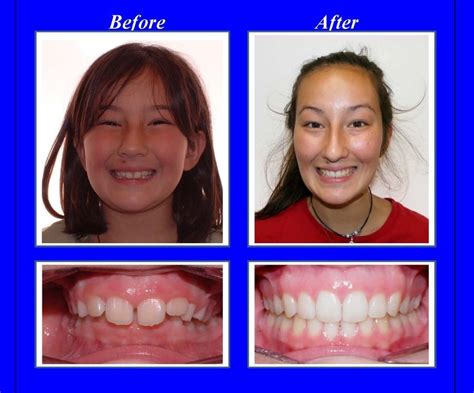 This patient had a severe overbite. We used Invisalign aligners with ...