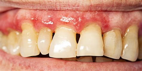 Common Causes and Treatment of Periodontal Disease | Dr. Alex Midtown NYC Cosmetic Dentist