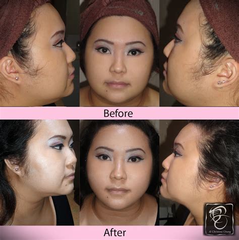 Wana get a V-Shaped face? Go to CSK Aesthetics Clinic | Colour Huney