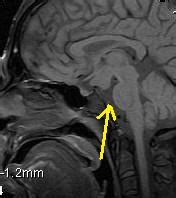 Tuber cinereum hamartoma-MRI - Sumer's Radiology Blog