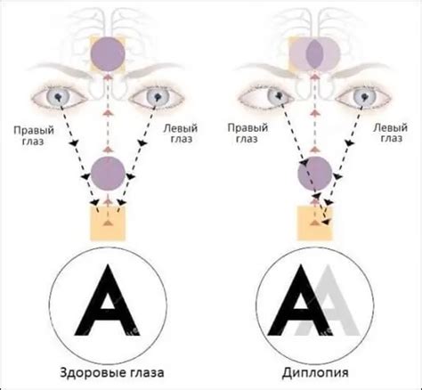 Double in one eye (monocular diplopia): causes and treatments | Vision 2024