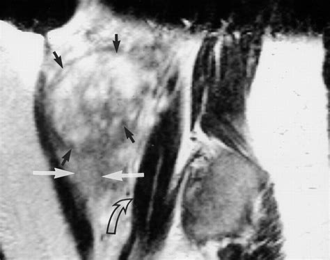 Nonoperative Treatment of Placenta Percreta Value of MR Imaging | AJR