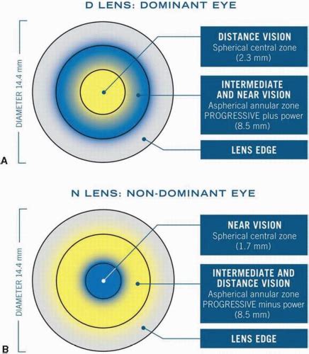 Bifocal Contact Lenses | Ento Key