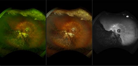 California - Peripapillary Atrophy with Chronic Partial Retinal Detachment and Atrophic Retinal ...