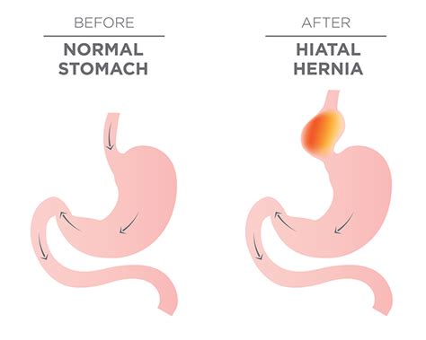 Hiatal Hernia Pain: Why It's Happening and How to Treat It - University Health News