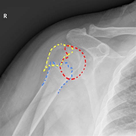 Proximal humerus fracture - wikidoc