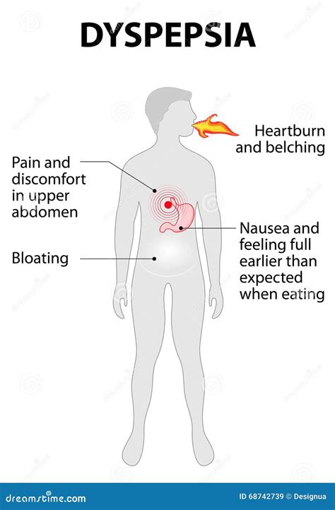 Indigestion Or Dyspepsia Stock Vector - Image: 68742739