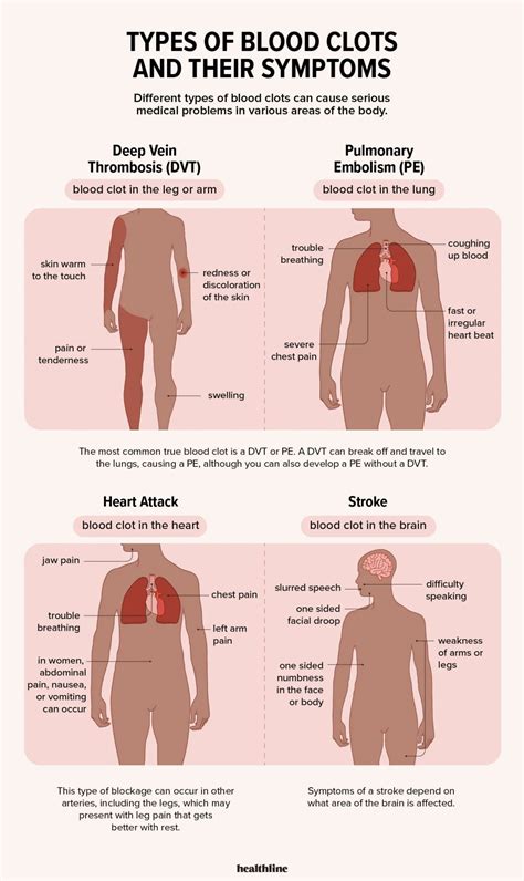 Blood Clot Symptoms: How Do You Know if You Have One?