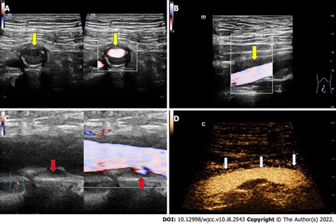 The ultrasound images of the artery. A: The transverse ultrasound image... | Download Scientific ...