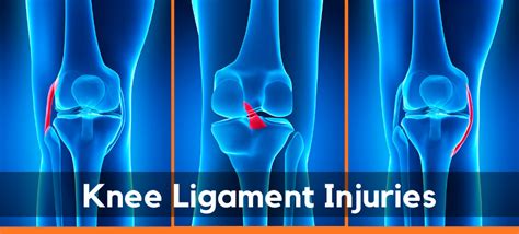 Torn Anterior Cruciate Ligament Stock Photo Download Image Now Anterior Cruciate Ligament, Torn ...