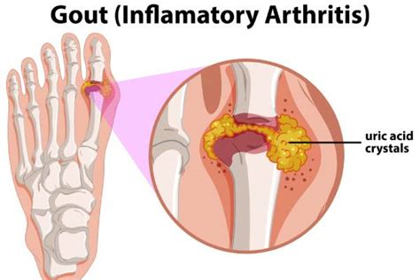 Can You Have Tophi With Gout? - Dr. Naveen Bhadauria | Private ...