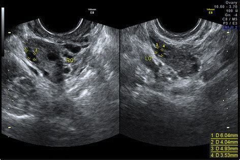 Ovarian Follicle Ultrasound