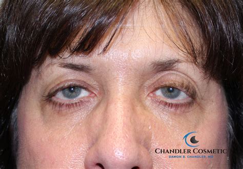 Ptosis (Droopy Eyelids) - Chandler Cosmetic | Dr. Damon B. Chandler