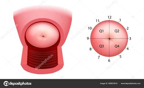 Cervix Quadrants Directions Anatomical Position Cervix Colposcopy ...