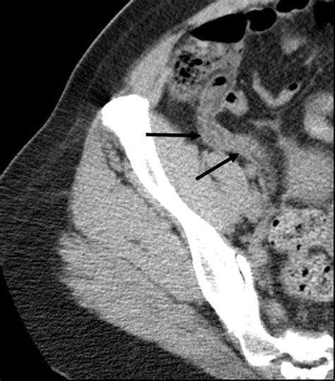 CT Evaluation of Appendicitis and Its Complications: Imaging Techniques and Key Diagnostic ...