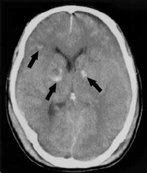 Diffuse axonal injury. Non-enhanced CT shows multiple punctuate...