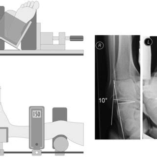 a Combined ankle instability and subtalar joint osteoarthritis with ...