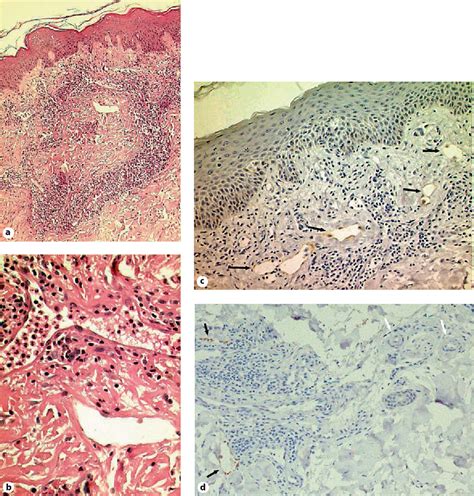 Superficial Lymphangitis after Arthropod Bite: A Distinctive but ...