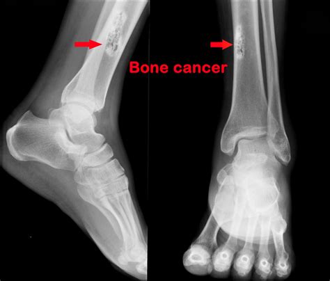 Lista 103+ Foto Imágenes De Tumor En La Rodilla Cena Hermosa