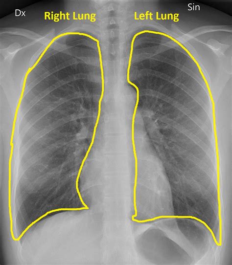 Radiology: Normal Chest X-Rays – Glass Box