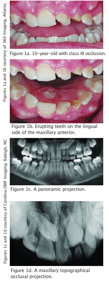 Radiography and the Mixed Dentition - Dimensions of Dental Hygiene