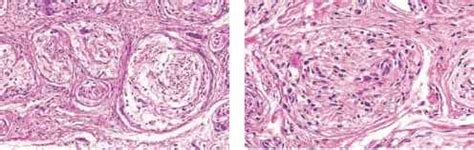 Plexiform Neurofibroma - Cell Carcinoma - Derick Mussen Healthcare