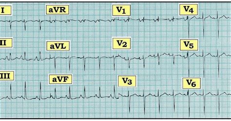 ECG Interpretation: ECG Interpretation Review #77 (Chamber Enlargement ...