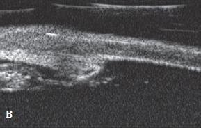 B: UBM showing peripheral anterior synechiae. | Download Scientific Diagram