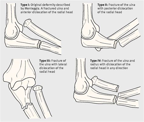 Forearm injury in a 5 year old boy | The BMJ