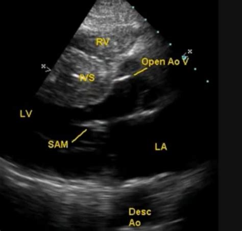 What is SAM in the heart? – All About Cardiovascular System and Disorders